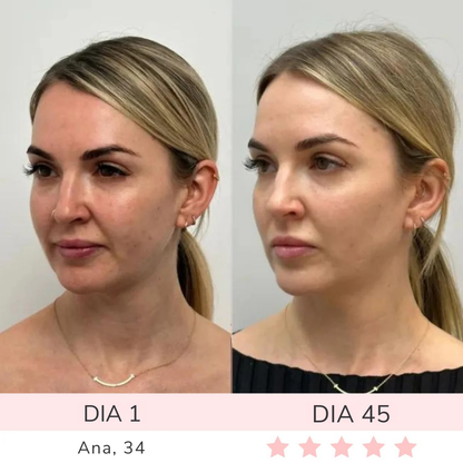 Luméa™ – Escultor Facial LED 3 en 1