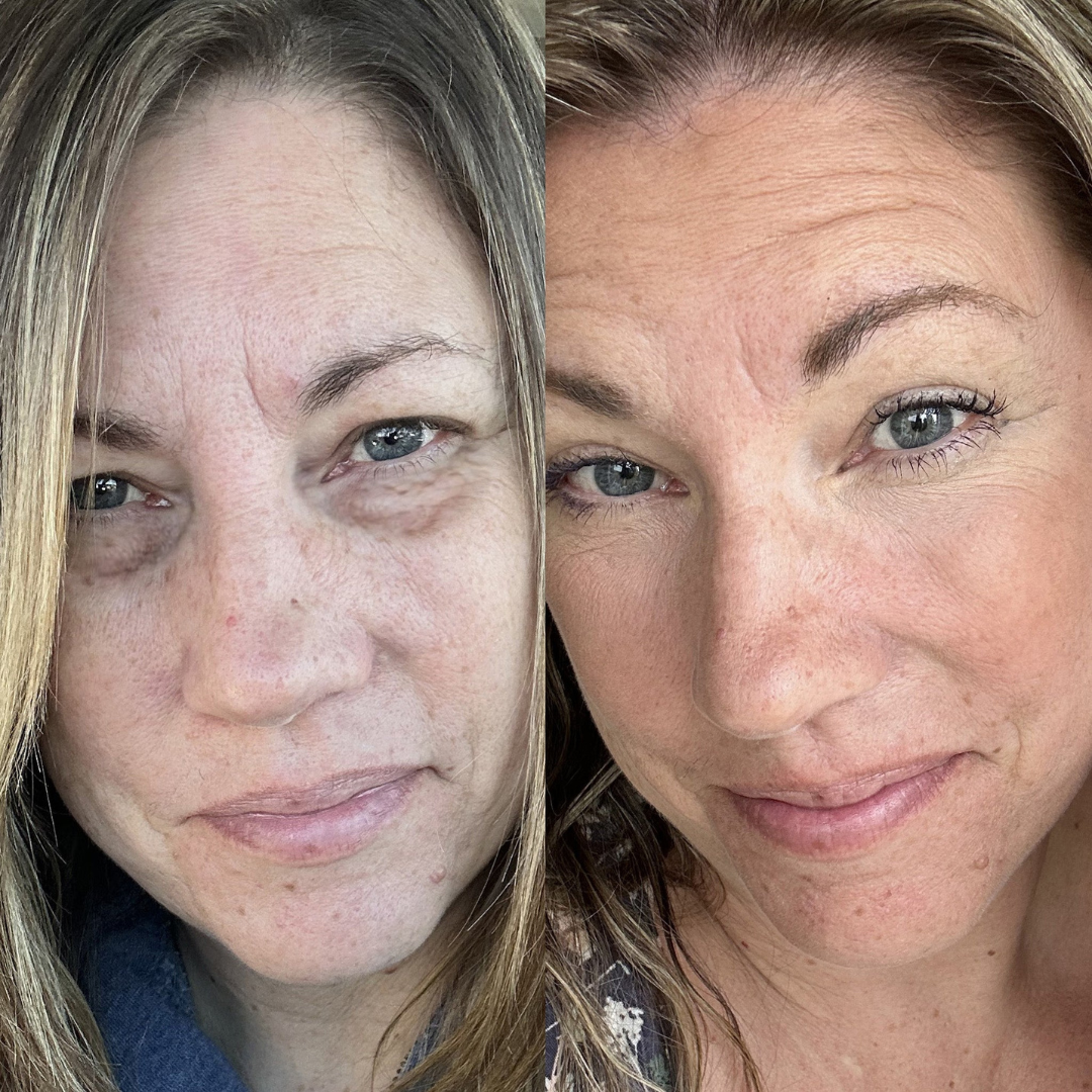 DualLift PRO™ Luz Roja + EMS para Contorno de Ojos (ojeras)