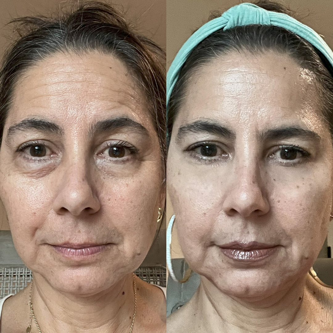 DualLift PRO™ Luz Roja + EMS para Contorno de Ojos (ojeras)