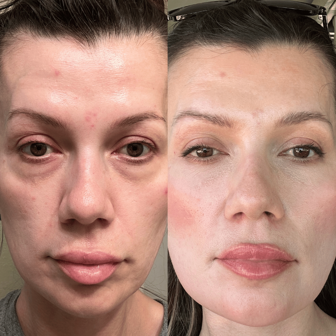 DualLift PRO™ Luz Roja + EMS para Contorno de Ojos (ojeras)